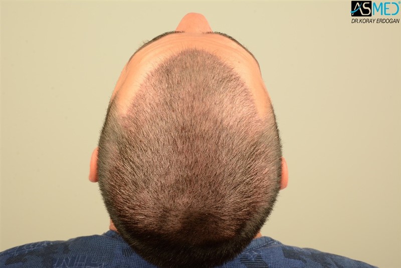 Before and After  graft    transplant at 