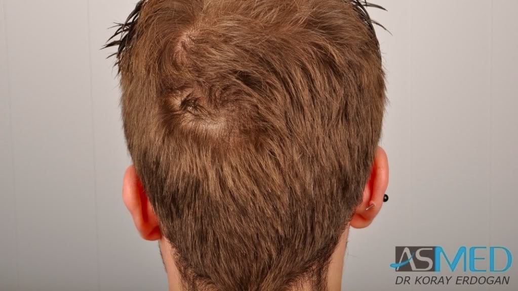 Before and After  graft    transplant at 