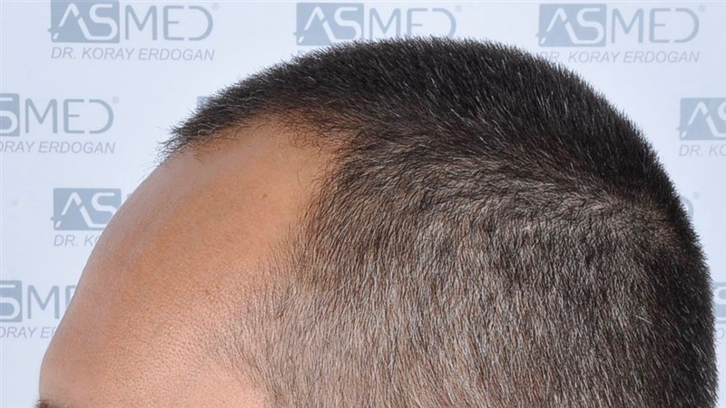 Before and After  graft    transplant at 