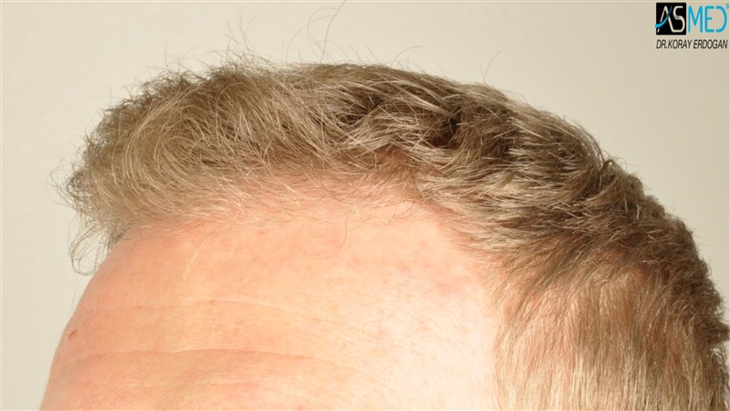 Before and After  graft    transplant at 