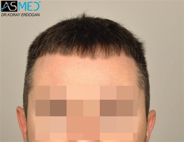 Before and After  graft    transplant at 