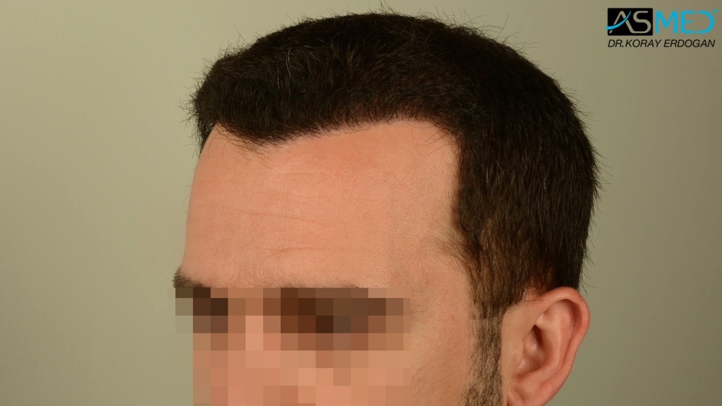 FUE Hair Transplant Result
