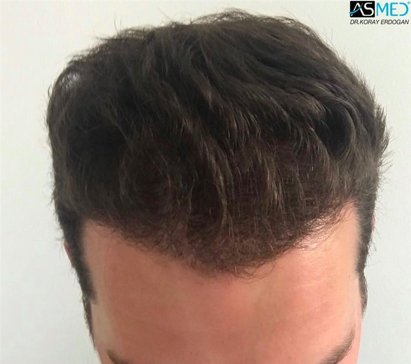 Before and After  graft    transplant at 