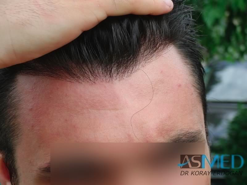 Before and After  graft    transplant at 