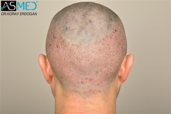 Before and After  graft    transplant at 