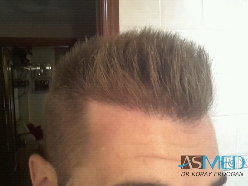 Before and After  graft    transplant at 