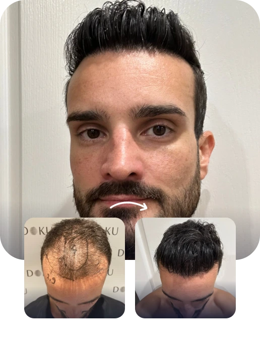 DHI Hair Transplant Result