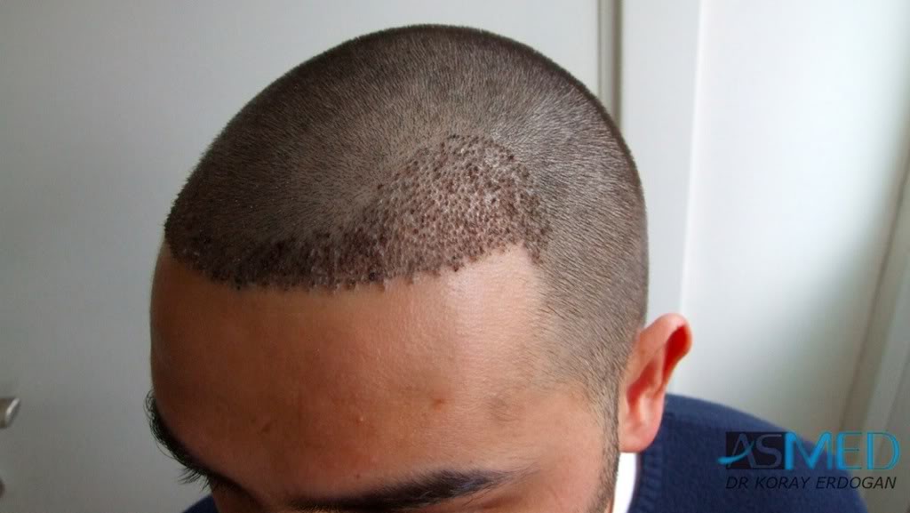 Before and After  graft    transplant at 