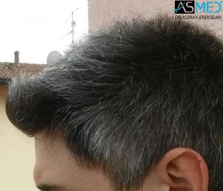 FUE Hair Transplant Result