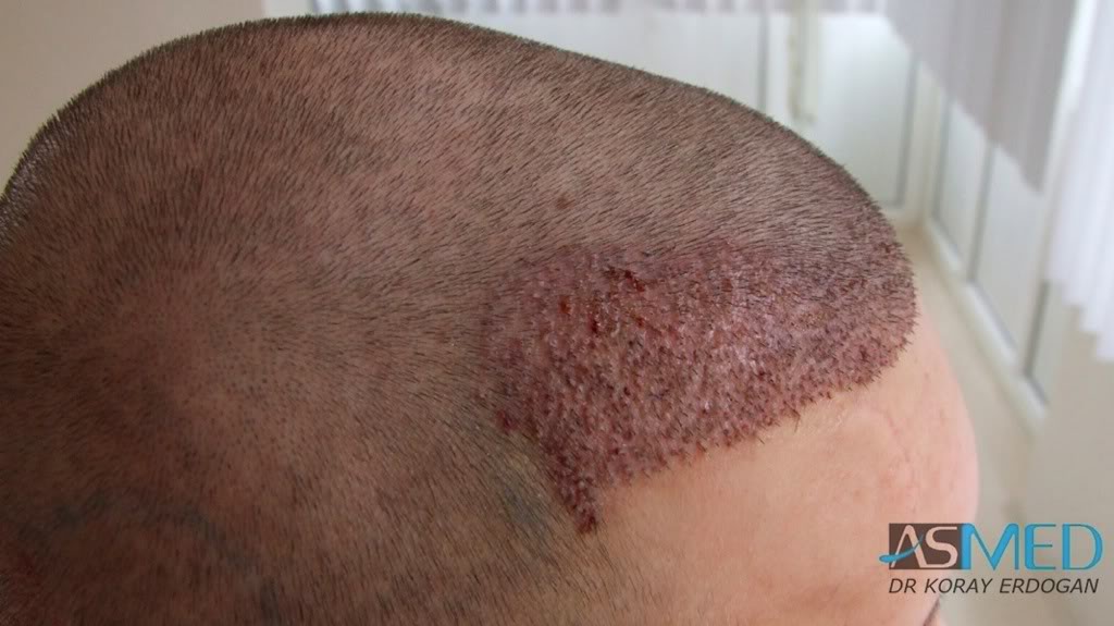 Before and After  graft    transplant at 