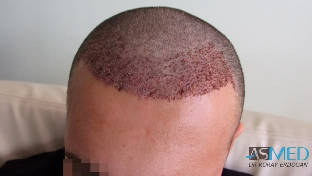 Before and After  graft    transplant at 