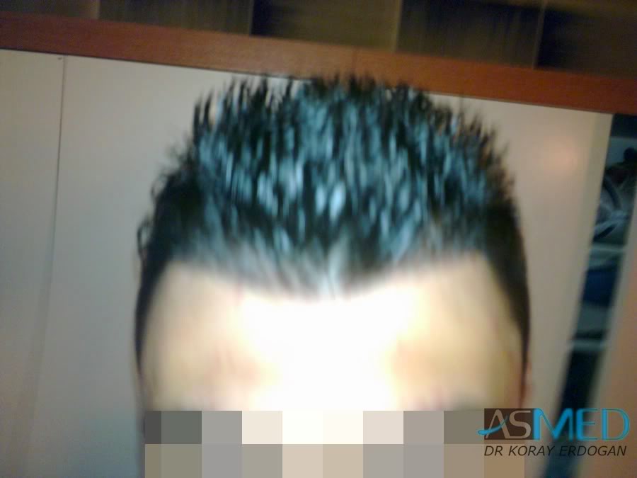 Before and After 1800 graft  FUE hair transplant at ASMED Medical Center