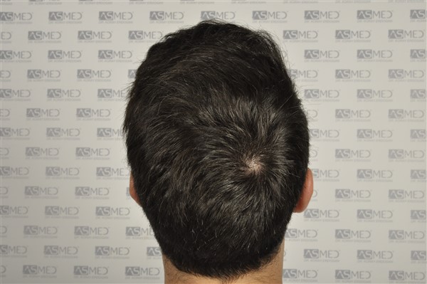 Before and After  graft    transplant at 
