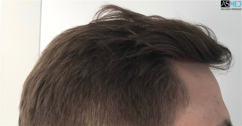 FUE Hair Transplant Result