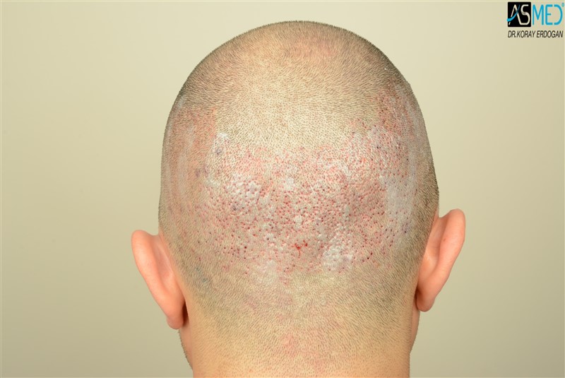 Before and After  graft    transplant at 