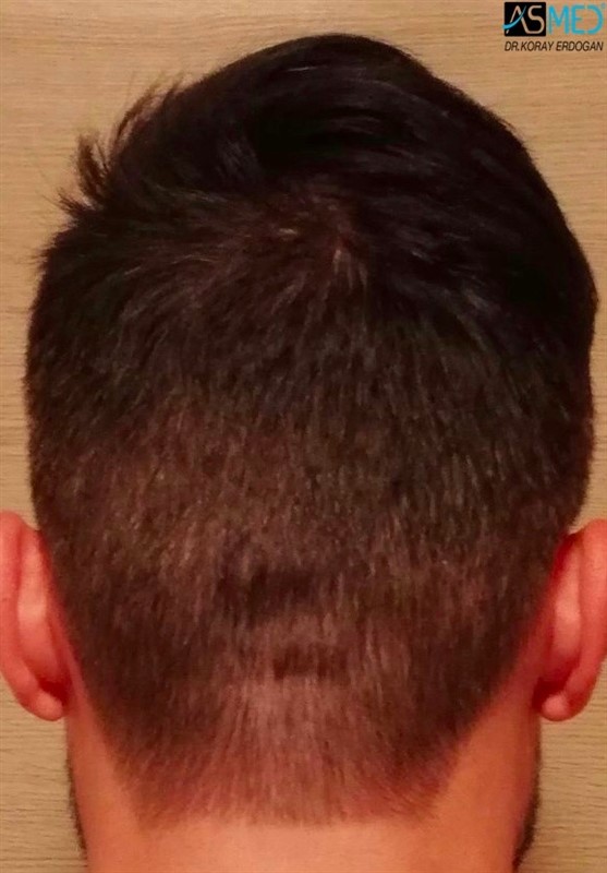 Before and After  graft    transplant at 