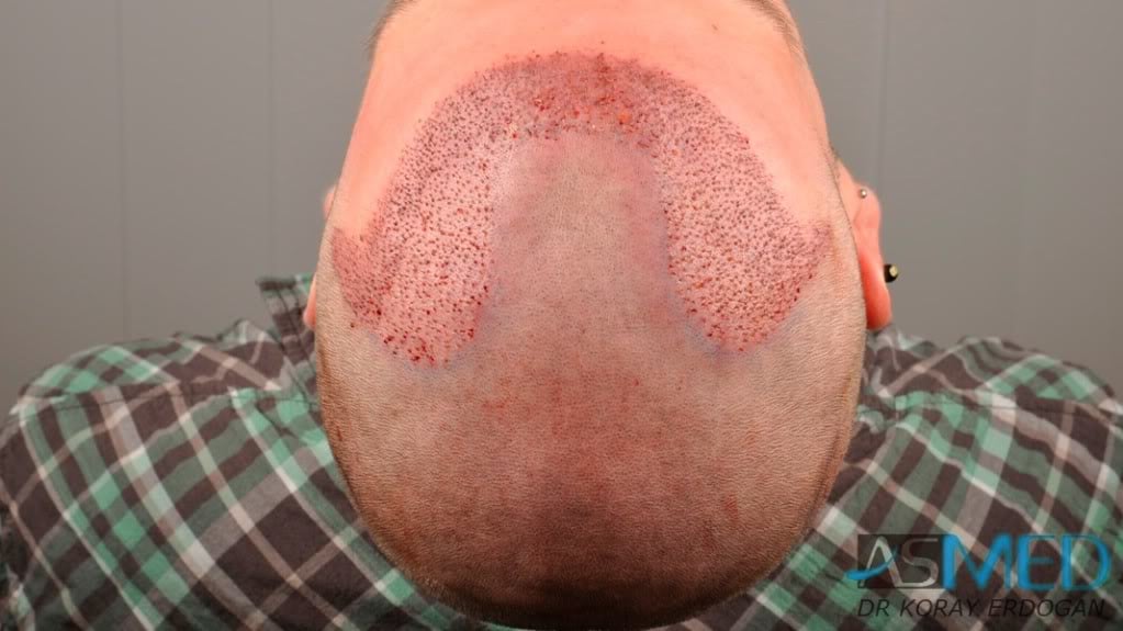 Before and After  graft    transplant at 
