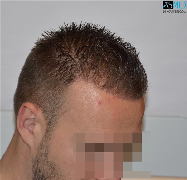 FUE Hair Transplant Result