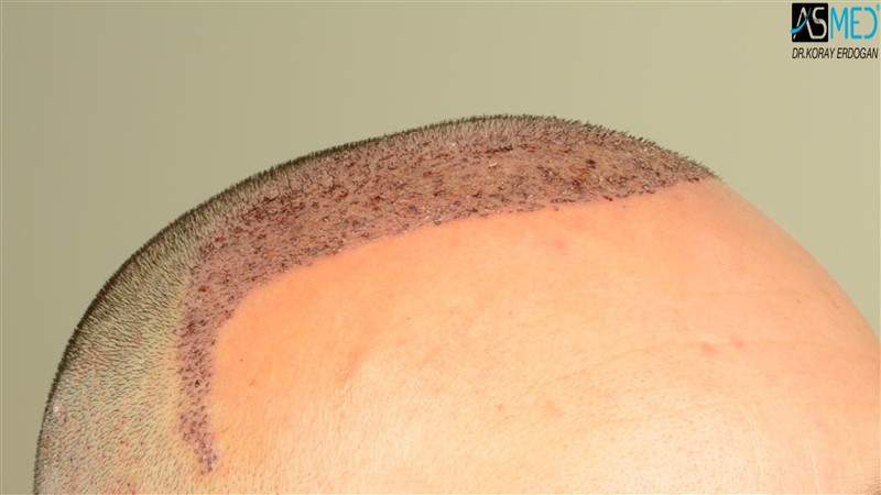 Before and After  graft    transplant at 