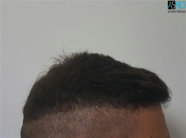 FUE Hair Transplant Result