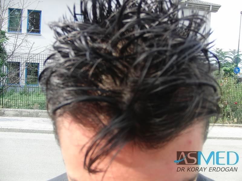 Before and After  graft    transplant at 