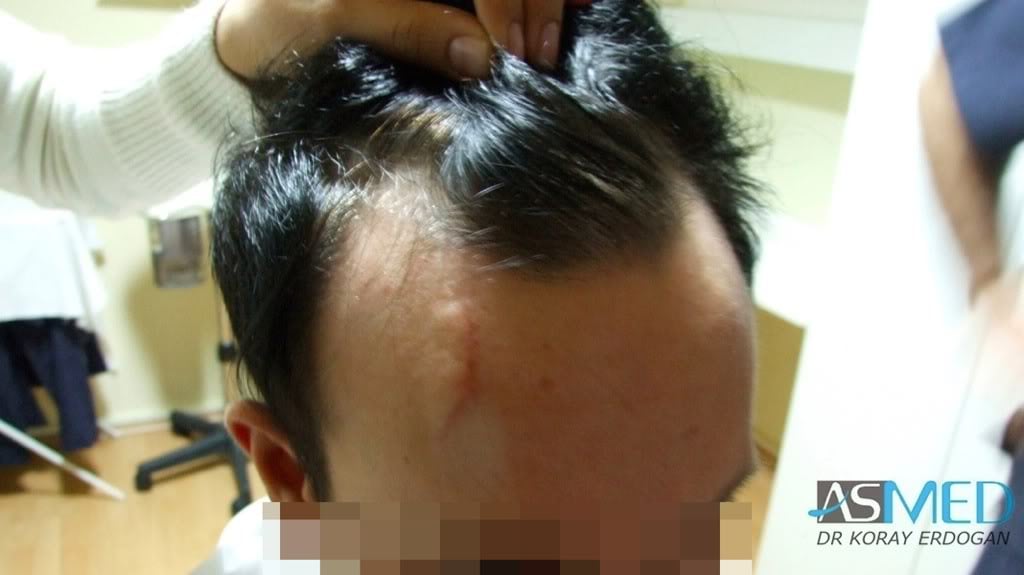Before and After  graft    transplant at 