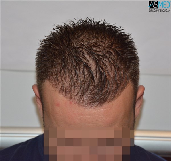 FUE Hair Transplant Result