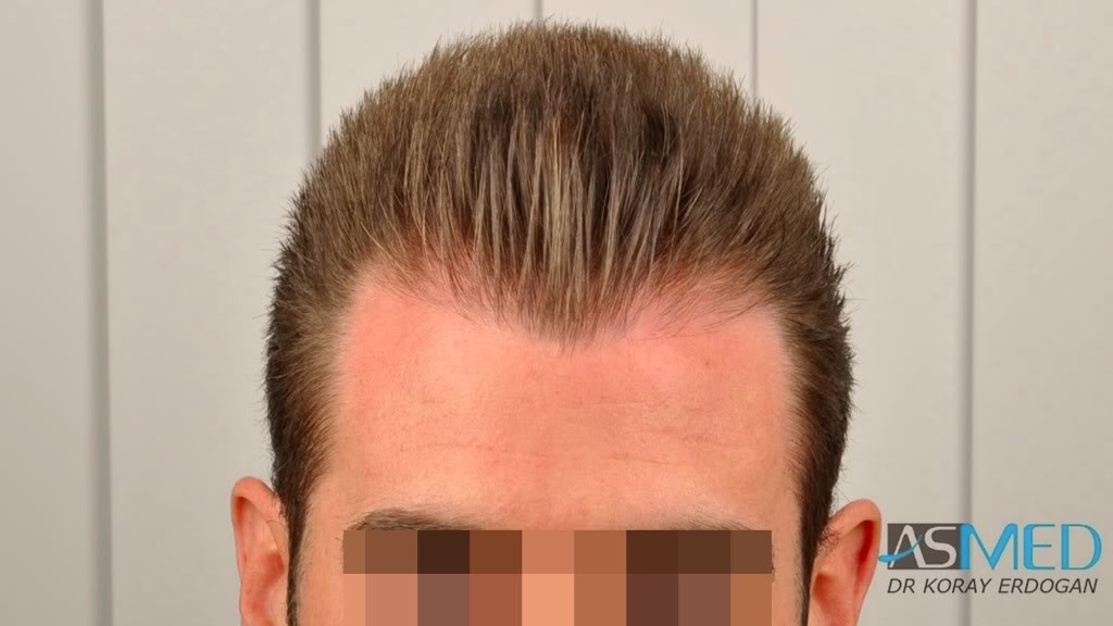 Before and After  graft    transplant at 