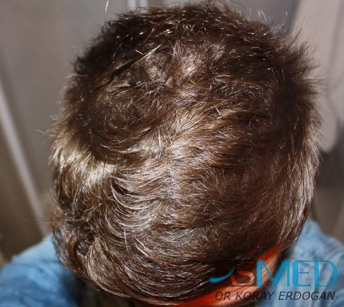 Before and After  graft    transplant at 