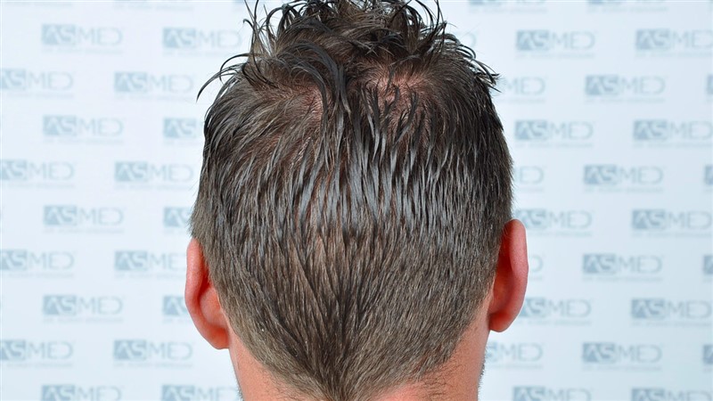 Before and After  graft    transplant at 