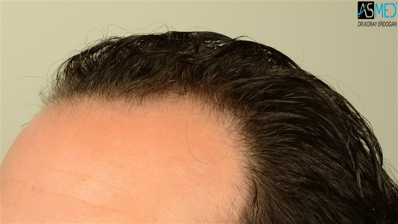 Before and After  graft    transplant at 