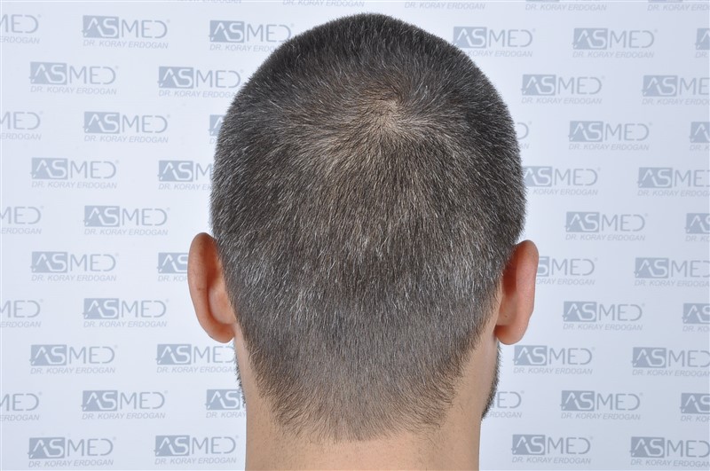 Before and After  graft    transplant at 