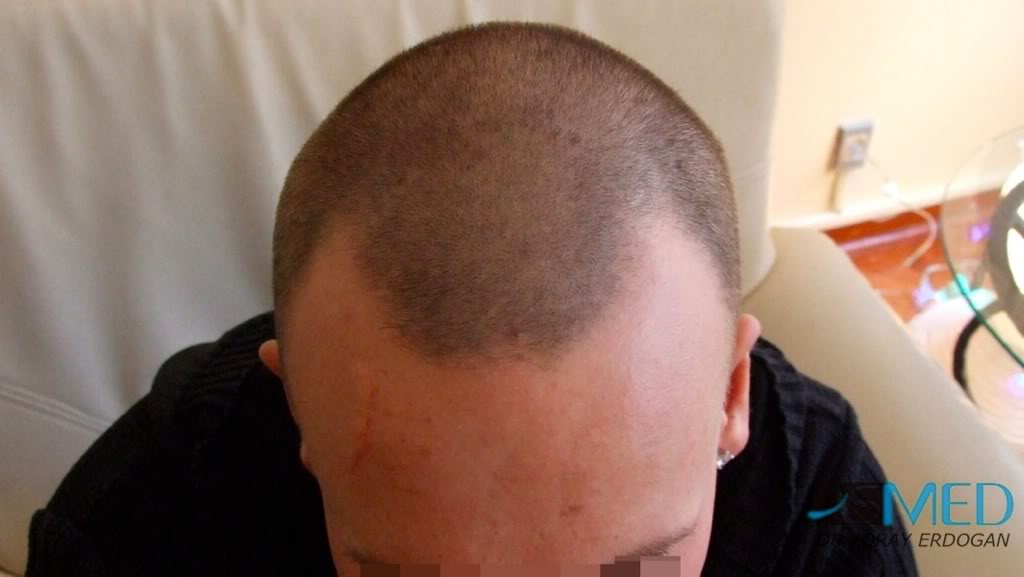 Before and After  graft    transplant at 