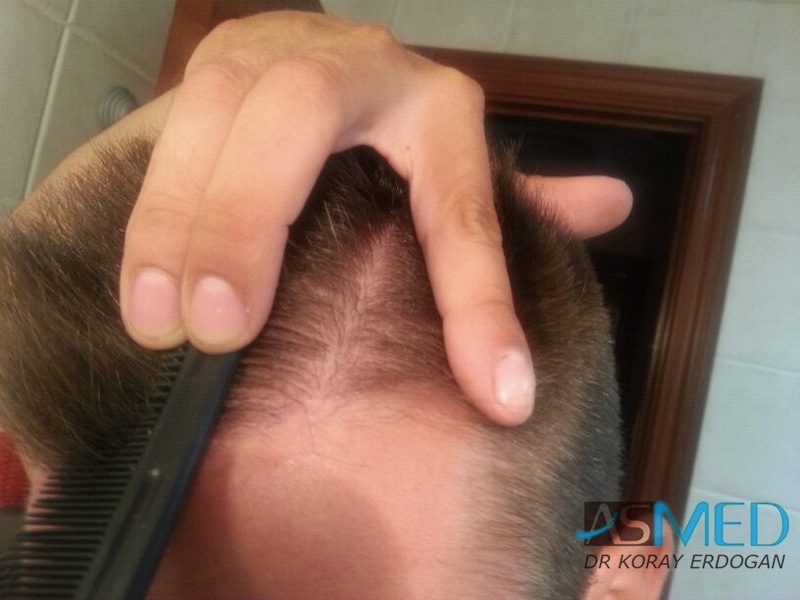 Before and After  graft    transplant at 