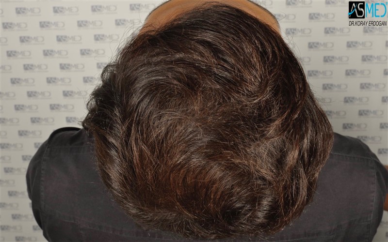 Before and After  graft    transplant at 