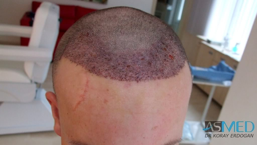 Before and After  graft    transplant at 