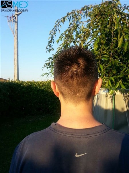 Before and After  graft    transplant at 