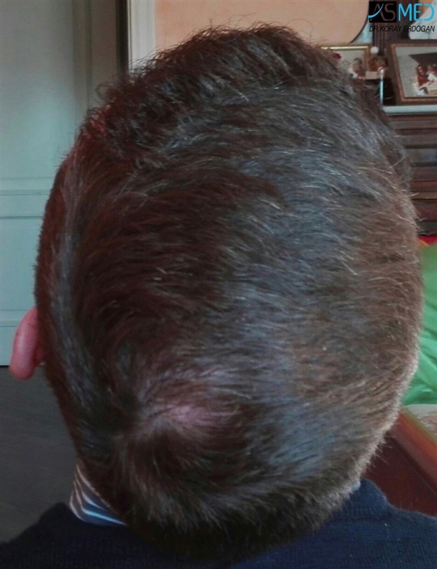 FUE Hair Transplant Result