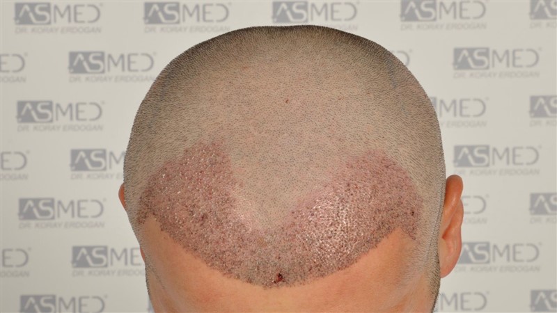 Before and After  graft    transplant at 