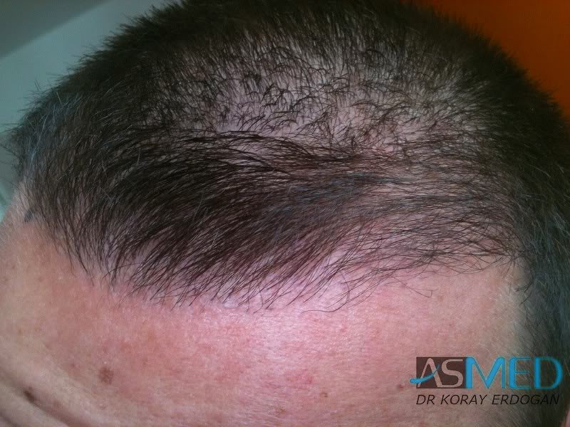 Before and After  graft    transplant at 