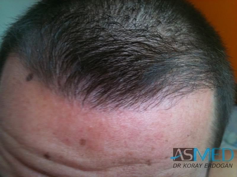 Before and After  graft    transplant at 