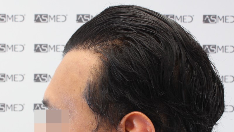 FUE Hair Transplant Result