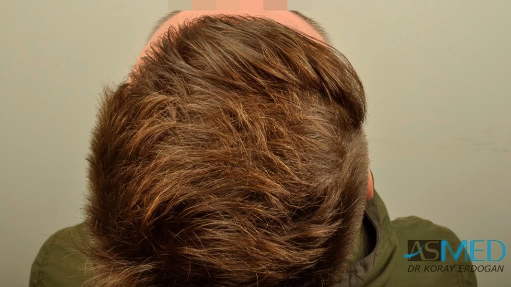 Before and After  graft    transplant at 