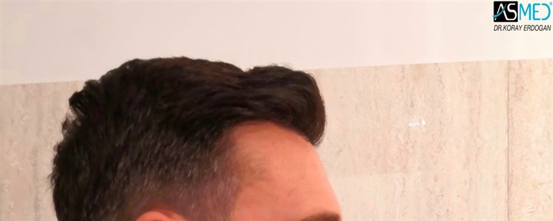 Before and After  graft    transplant at 