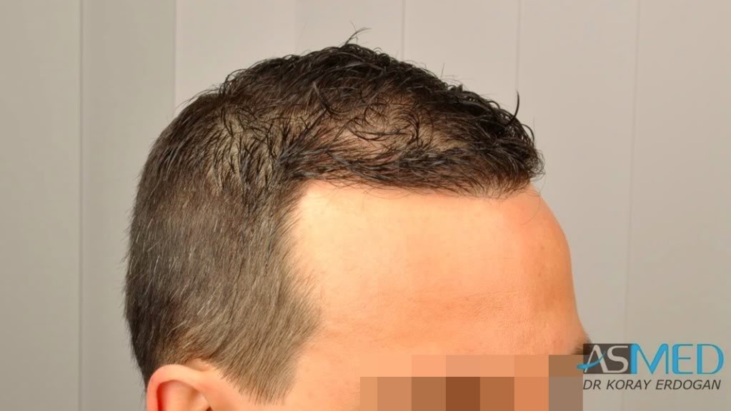 FUE Hair Transplant Result