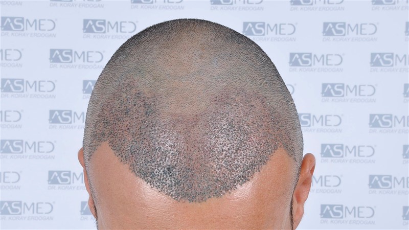 Before and After  graft    transplant at 
