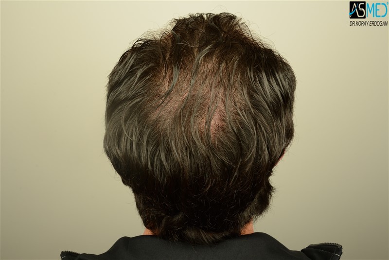 Before and After  graft    transplant at 