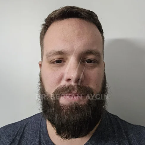 DHI Hair Transplant Result