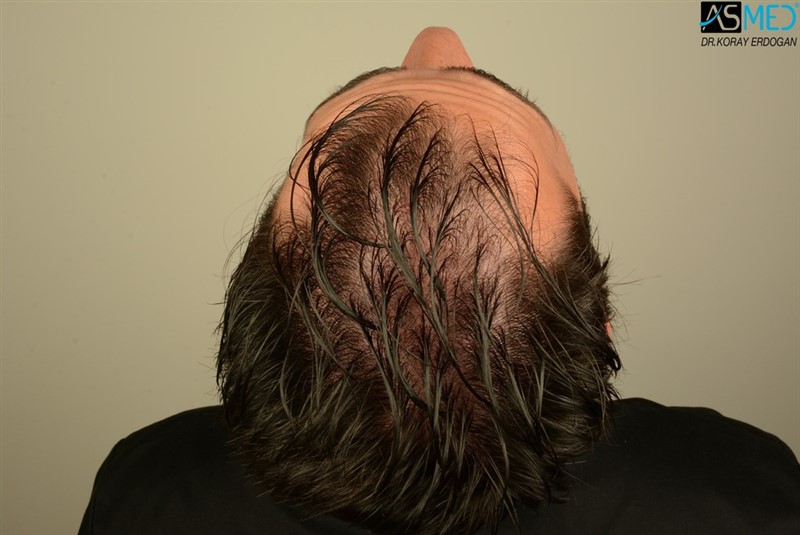 Before and After  graft    transplant at 