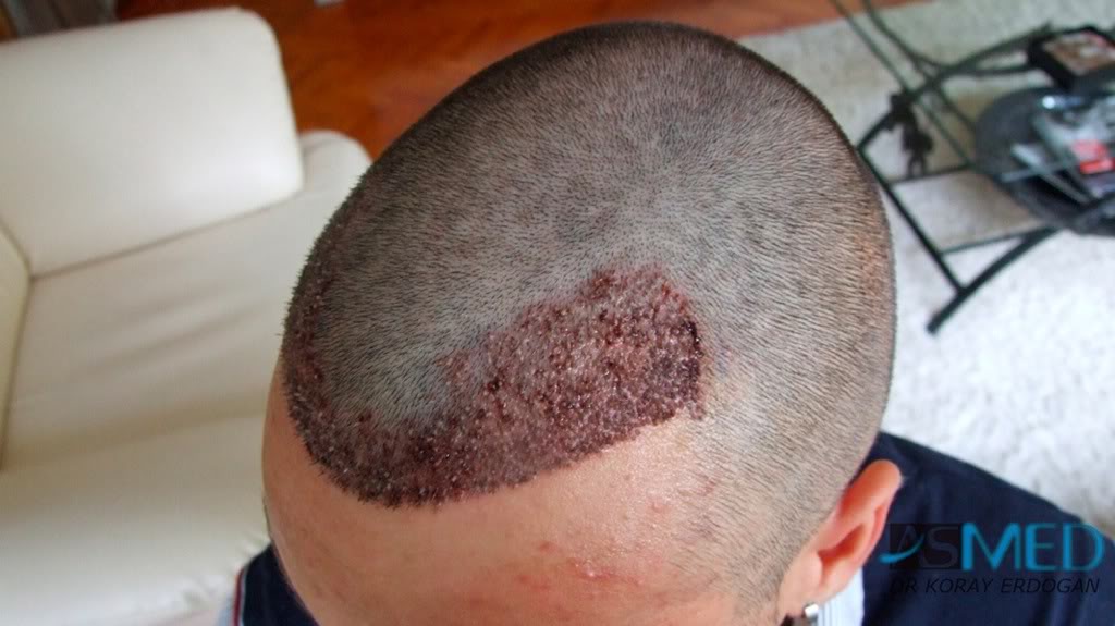 Before and After  graft    transplant at 
